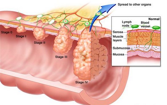 Стадии развития рака кишечника