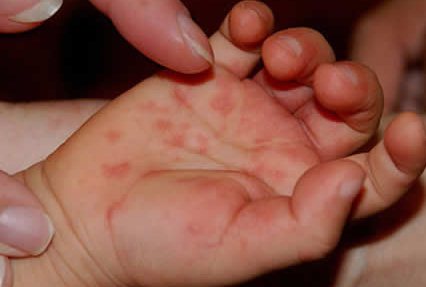 У пяти малышей из детского сада в Ревде подозревают энтеровирусную инфекцию