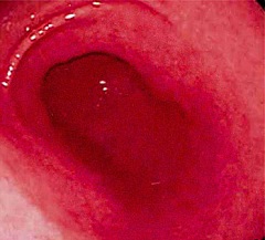 Гастрит - воспаление слизистой оболочки желудка