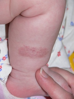 Небольшое пятнышко - чаще всего вид гемангиомы у новорожденных