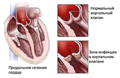 Ревматизм сердца