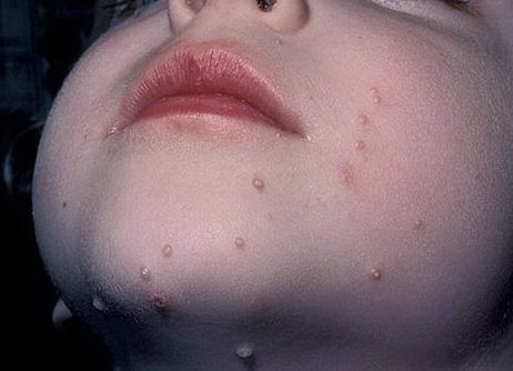 Ребенок заразившийся контагиозным моллюском
