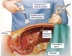 Лечение перитонита хирургическим путем