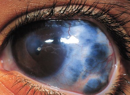 Вроженная глаукома