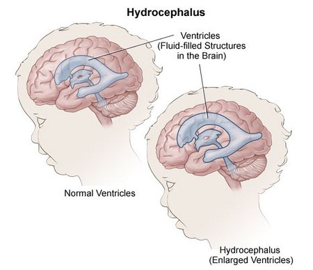 Гидроцефалия головного мозга