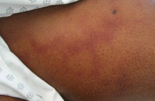 Симптомы стронгилоидоза под кожей