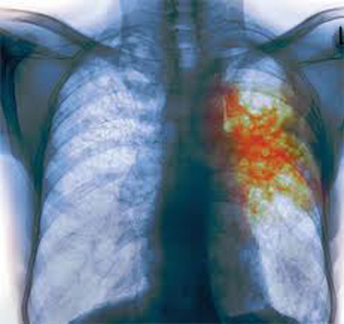 Рентген больного туберкулезом человека