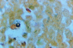 Лимфогранулематоз – pлокачественная опухоль, образованная клетками лимфоидной ткани