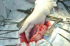 Операцию при врожденном пороке сердца назначают, если нет возможности использовать катетеризацию