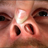 Чем опасно искривление перегородки носа