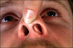 Чем опасно искривление перегородки носа