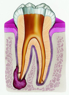 Что такое киста на корнет зуба