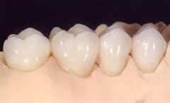 Какие бывают виды протезирования зубов