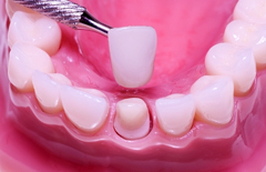 Зубные коронки могут изготавливаться из различных материалов