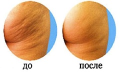 До и после курса антицеллюлитного массажа