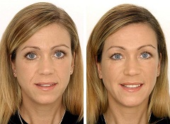 До и после контурной пластики лица