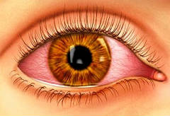 Комбинил применяется при инфекционно-воспалительных заболеваниях глаза и его придатков