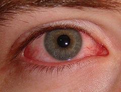 Синдром хронической усталости глаз