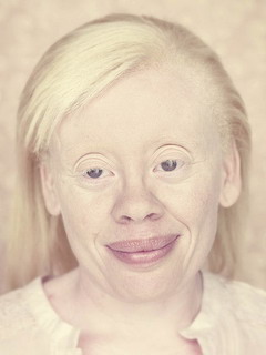 Альбинизм у взрослых