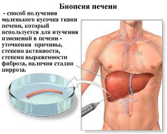 Биопсия - один из способов диагностики цирроза печени