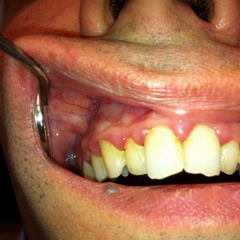 При отсутствии стоматологической патологии больной с галитозом нуждается в консультации гастроэнтеролога