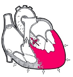 Гипертрофия левого желудочка сердца - аномальное отклонение
