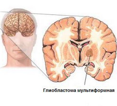 Глиобластома – опухоль головного мозга