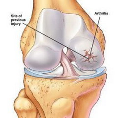 Инфекционный артрит – сложное инфекционное заболевание суставов