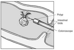 Удаление - хирургический метод лечения полипов прямой кишки