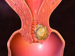 Рак эндометрия является лидером по распространенности среди всех онкологических заболеваний