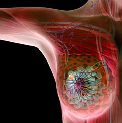 Рак молочной железы - наиболее частый вид злокачественной опухоли у женщин