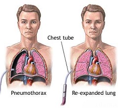 Возрастающая при глубоком дыхании - один из симптомов пневмоторакса