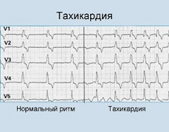 Тахикардия - увеличение частоты сердечных сокращений