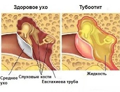 Тубоотит - воспаление слизистой оболочки внутреннего уха