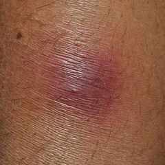 Узловатая эритема – болезнь, при которой возникает воспаление подкожно-жировой клетчатки и сосудов кожи