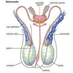 Обратный кровоток в яичковой вене - причина варикоцеле