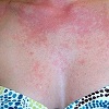 Аллергия на солнце: причины и способы устранения