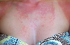 Аллергия на солнце - причины и способы устранения