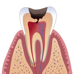 Еще одной причиной, почему болит зуб после удаления нерва, может являться воспаление тройничного нерва