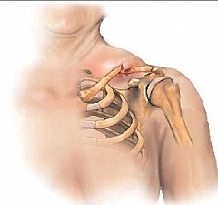 Смещение плеча - симптом перелома ключицы со смещением