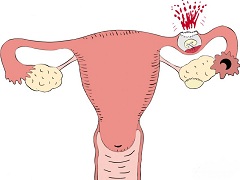 Внематочная - беременность, развивающаяся вне полости матки