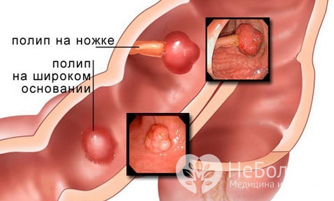 Как выглядят полипы желудочно-кишечного тракта