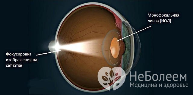 Интраокулярная коррекция афакии заключается во вживлении в глазное яблоко линзы необходимой оптической силы