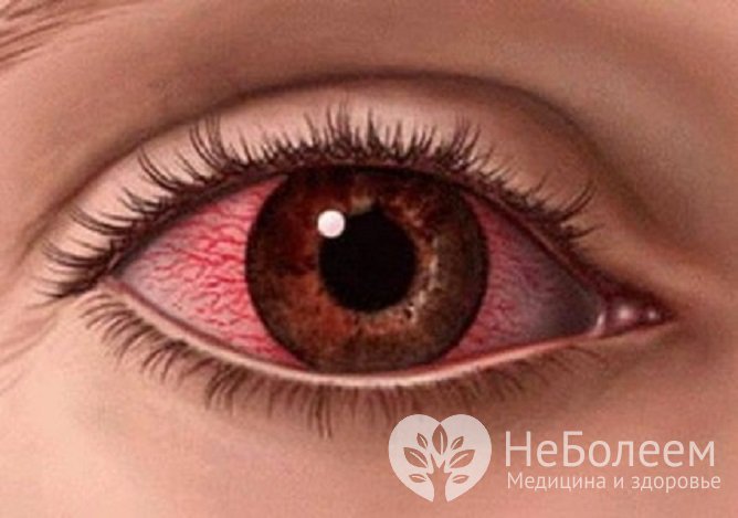 Акантамебный кератит сопровождается отеком и сильной болью в глазу