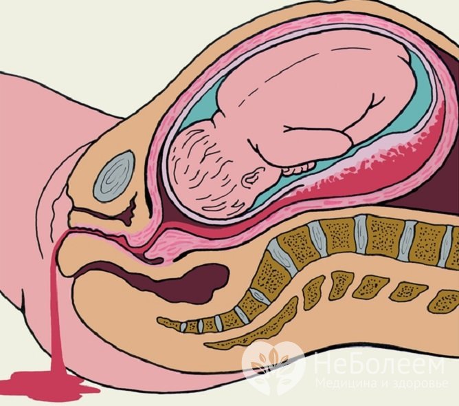 Акушерские кровотечения возникают во время беременности, родов или в раннем послеродовом периоде