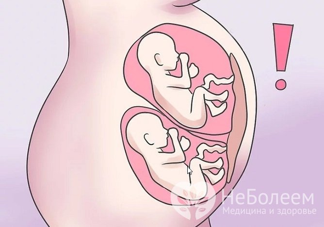 Фактором риска развития акушерского кровотечения является и многоплодная беременность