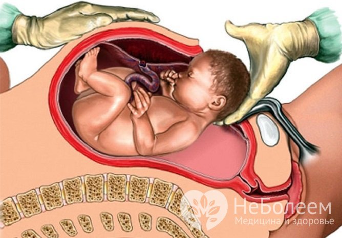 При массивной акушерском кровотечении на поздних сроках беременности проводят экстренное кесарево сечение