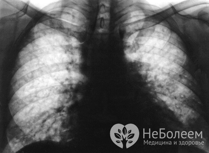 Экзогенный альвеолит легких на рентгеновском снимке