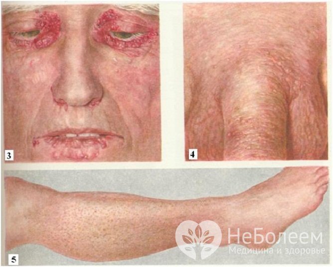 Симптомы амилоидоза кожи