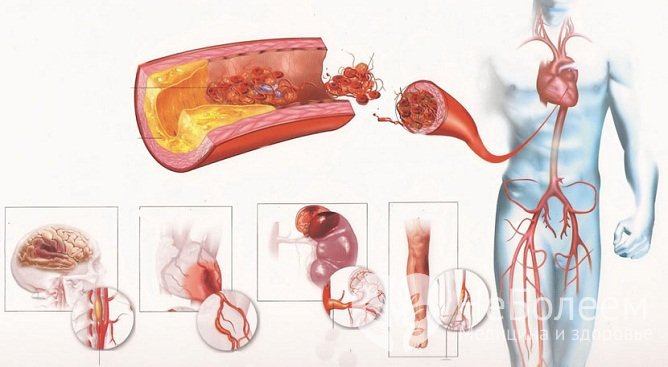 Атеросклероз стенки аорты – основная причина аневризмы аорты